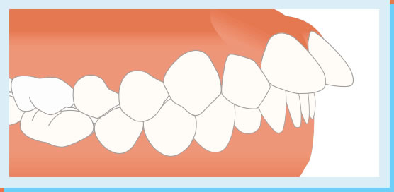 上顎前突（出っ歯）