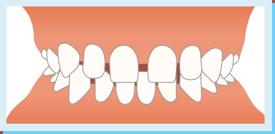 空隙歯列（すきっ歯）